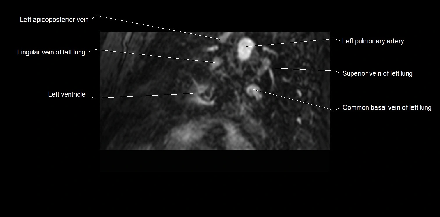 MRI heart and coronary arteries two chamber(sagittal)  anatomy image 40.webp